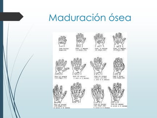 Maduración ósea
 