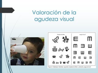 Valoración de la
agudeza visual
 
