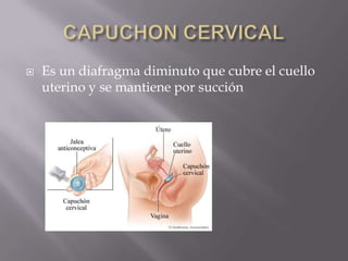    Es un diafragma diminuto que cubre el cuello
    uterino y se mantiene por succión
 