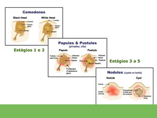 Estágios 1 e 2

                 Estágios 3 a 5
 