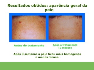 Resultados obtidos: aparência geral da
                 pele




   Antes do tratamento    Após o tratamento
                             (2 meses)

  Após 8 semanas a pele ficou mais homogênea
               e menos oleosa.
 