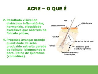 ACNE – O QUE É

2. Resultado visível de
   distúrbios inflamatórios,
   hormonais, oleosidade
   excessiva que ocorrem no
   folículo piloso;

4. Processo avança: grande
   quantidade de sebo
   produzido estreita parede
   do folículo bloqueando o
   poro. Rolha de queratina
   (comedões).
 