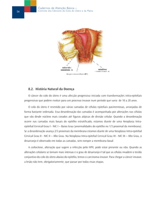 8.2. História Natural da Doença
O câncer do colo do útero é uma afecção progressiva iniciada com transformações intra-epiteliais
progressivas que podem evoluir para um processo invasor num período que varia de 10 a 20 anos.
O colo do útero é revestido por várias camadas de células epiteliais pavimentosas, arranjadas de
forma bastante ordenada. Essa desordenação das camadas é acompanhada por alterações nas células
que vão desde núcleos mais corados até figuras atípicas de divisão celular. Quando a desordenação
ocorre nas camadas mais basais do epitélio estratificado, estamos diante de uma Neoplasia Intra-
epitelial Cervical Grau I - NIC I – Baixo Grau (anormalidades do epitélio no 1/3 proximal da membrana).
Se a desordenação avança 2/3 proximais da membrana estamos diante de uma Neoplasia Intra-epitelial
Cervical Grau II - NIC II – Alto Grau. Na Neoplasia Intra-epitelial Cervical Grau III - NIC III – Alto Grau, o
desarranjo é observado em todas as camadas, sem romper a membrana basal.
A coilocitose, alteração que sugere a infecção pelo HPV, pode estar presente ou não. Quando as
alterações celulares se tornam mais intensas e o grau de desarranjo é tal que as células invadem o tecido
conjuntivo do colo do útero abaixo do epitélio, temos o carcinoma invasor. Para chegar a câncer invasor,
a lesão não tem, obrigatoriamente, que passar por todas essas etapas.
54
Cadernos de Atenção Básica –
Controle dos Cânceres do Colo do Útero e da Mama
 