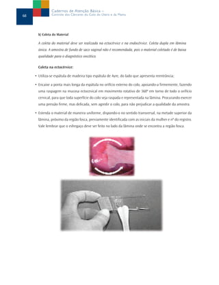 b) Coleta do Material
A coleta do material deve ser realizada na ectocérvice e na endocérvice. Coleta dupla em lâmina
única. A amostra de fundo de saco vaginal não é recomendada, pois o material coletado é de baixa
qualidade para o diagnóstico oncótico.
Coleta na ectocérvice:
• Utiliza-se espátula de madeira tipo espátula de Ayre, do lado que apresenta reentrância;
• Encaixe a ponta mais longa da espátula no orifício externo do colo, apoiando-a firmemente, fazendo
uma raspagem na mucosa ectocevical em movimento rotativo de 360º em torno de todo o orifício
cervical, para que toda superfície do colo seja raspada e representada na lâmina. Procurando exercer
uma pressão firme, mas delicada, sem agredir o colo, para não prejudicar a qualidade da amostra.
• Estenda o material de maneira uniforme, dispondo-o no sentido transversal, na metade superior da
lâmina, próximo da região fosca, previamente identificada com as iniciais da mulher e nº do registro.
Vale lembrar que o esfregaço deve ser feito no lado da lâmina onde se encontra a região fosca.
68
Cadernos de Atenção Básica –
Controle dos Cânceres do Colo do Útero e da Mama
 