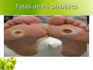 Fotos de Pé Diabético
 