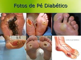Fotos de Pé DiabéticoFotos de Pé Diabético
 