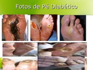 Fotos de Pé Diabético

 