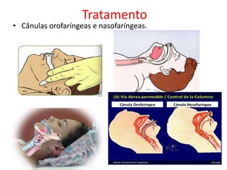 Tratamento
• Cânulas orofaríngeas e nasofaríngeas.
 