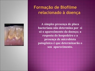 Formação de Biofilme
relacionado à doença
A simples presença de placa
bacteriana não determina por si
só o aparecimento da doença; a
resposta do hospedeiro e a
presença de microbiota
patogênica é que determinarão o
seu aparecimento.
 