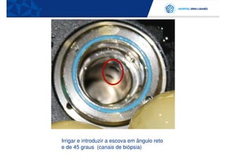 Irrigar e introduzir a escova em ângulo reto
e de 45 graus (canais de biópsia)
 