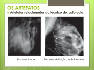 OS ARTEFATOS 
 Artefatos relacionados ao técnico de radiologia 
Ecran molhado Perca de definição por bolha de ar 
 