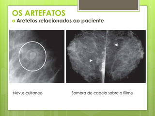 OS ARTEFATOS 
 Aretetos relacionados ao paciente 
Nevus cultaneo Sombra de cabelo sobre o fiilme 
 