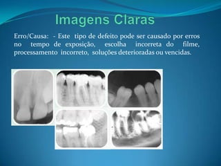 Erro/Causa: - Este tipo de defeito pode ser causado por erros
no tempo de exposição, escolha incorreta do filme,
processamento incorreto, soluções deterioradas ou vencidas.
 