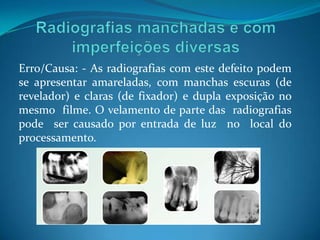 Erro/Causa: - As radiografias com este defeito podem
se apresentar amareladas, com manchas escuras (de
revelador) e claras (de fixador) e dupla exposição no
mesmo filme. O velamento de parte das radiografias
pode ser causado por entrada de luz no local do
processamento.
 