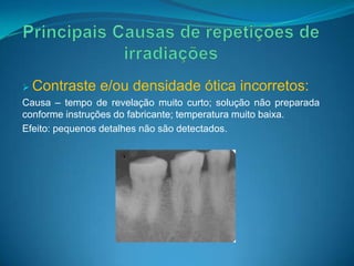  Contraste    e/ou densidade ótica incorretos:
Causa – tempo de revelação muito curto; solução não preparada
conforme instruções do fabricante; temperatura muito baixa.
Efeito: pequenos detalhes não são detectados.
 