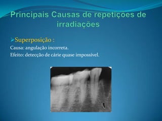 Superposição :
Causa: angulação incorreta.
Efeito: detecção de cárie quase impossível.
 