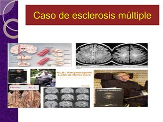 Caso de esclerosis múltiple
 