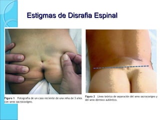 Estigmas de Disrafia EspinalEstigmas de Disrafia Espinal
 
