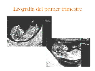 Ecografía del primer trimestre
 