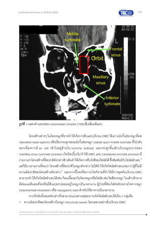 133
เอกสารประกอบการประชุมวิชาการประจาปี 2559 สมาคมสภาองค์กรโรคหืดแห่งประเทศไทย
Controversial Issues in Asthma 2016
Orbit
Maxillary
sinus
Frontal
sinus
Middle
turbinate
Inferior
turbinate
Orbit
Maxillary
sinus
Frontal
sinus
Middle
turbinate
Inferior
turbinate
รูปที่ 1 แสดงตาแหน่งของ ostiomeatal complex (กรอบสี่เหลี่ยมสีแดง)
โครงสร้างต่างๆ ในโพรงจมูกที่อาจทาให้เกิดการตีบแคบบริเวณ OMC ได้แก่ ผนังกั้นช่องจมูกที่คด
(deviated nasal septum) หรือเงี่ยงกระดูกของผนังกั้นช่องจมูก (septal spur) middle turbinate ที่โป่งตัว
ออกเนื่องจากมี air cell เข้าไปอยู่ด้านใน (concha bullosa) และกระดูกชิ้นเล็กบริเวณรูระบายของ
maxillarysinus (uncinate process) เกิดบิดเบี้ยวไป ทาให้ OMC แคบ (displaced uncinate process) มี
รายงานว่าโครงสร้างที่ผิดปกติดังกล่าวข้างต้นทาให้เกิดการทึบรังสีของไซนัสได้ ซึ่งสัมพันธ์กับไซนัสอักเสบ13
แต่ก็มีบางรายงานที่พบว่า โครงสร้างที่ผิดปกติในจมูกดังกล่าว ไม่ได้ทาให้เกิดไซนัสอักเสบบ่อยกว่าผู้ที่ไม่มี
ความผิดปกติของโครงสร้างดังกล่าว14
นอกจากนี้โรคหรือภาวะใดก็ตามที่ทาให้มีการอุดตันบริเวณ OMC
สามารถทาให้เกิดไซนัสอักเสบได้เช่น ก้อนเนื้องอกในโพรงจมูกหรือไซนัส เช่น ริดสีดวงจมูก ในเด็กเล็กอาจ
มีต่อมแอดีนอยด์โตหรือมีสิ่งแปลกปลอมอยู่ในจมูกเป็นเวลานาน ผู้ป่วยที่ต้องใส่ท่อช่วยหายใจทางจมูก
(nasotracheal intubation) หรือ nasogastric tube สาหรับให้อาหารเป็นเวลานาน
จากปัจจัยทั้งหมดดังกล่าวจึงสามารถแบ่งสาเหตุของการเกิดไซนัสอักเสบได้เป็น 2 กลุ่มคือ
1. ความผิดปกติของโครงสร้างในจมูก (structural cause) โดยเฉพาะอย่างยิ่งบริเวณ OMC
 