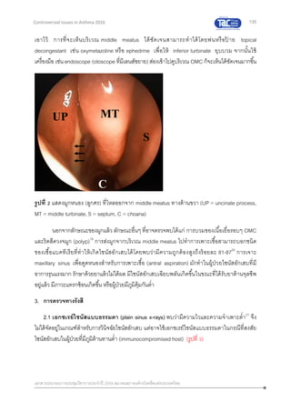 135
เอกสารประกอบการประชุมวิชาการประจาปี 2559 สมาคมสภาองค์กรโรคหืดแห่งประเทศไทย
Controversial Issues in Asthma 2016
เอาไว้ การที่จะเห็นบริเวณ middle meatus ได้ชัดเจนสามารถทาได้โดยพ่นหรือป้ าย topical
decongestant เช่น oxymetazoline หรือ ephedrine เพื่อให้ inferior turbinate ยุบบวม จากนั้นใช้
เครื่องมือ เช่น endoscope (otoscope ที่มีเลนส์ขยาย) ส่องเข้าไปดูบริเวณ OMC ก็จะเห็นได้ชัดเจนมากขึ้น
รูปที่ 2 แสดงมูกหนอง (ลูกศร) ที่ไหลออกจาก middle meatus ทางด้านขวา (UP = uncinate process,
MT = middle turbinate, S = septum, C = choana)
นอกจากลักษณะของมูกแล้ว ลักษณะอื่นๆ ที่อาจตรวจพบได้แก่ การบวมของเนื้อเยื่อรอบๆ OMC
และริดสีดวงจมูก (polyp)19
การส่งมูกจากบริเวณ middle meatus ไปทาการเพาะเชื้อสามารถบอกชนิด
ของเชื้อแบคทีเรียที่ทาให้เกิดไซนัสอักเสบได้โดยพบว่ามีความถูกต้องสูงถึงร้อยละ 81-8720
การเจาะ
maxillary sinus เพื่อดูดหนองสาหรับการเพาะเชื้อ (antral aspiration) มักทาในผู้ป่วยไซนัสอักเสบที่มี
อาการรุนแรงมาก รักษาด้วยยาแล้วไม่ได้ผล มีไซนัสอักเสบเฉียบพลันเกิดขึ้นในขณะที่ได้รับยาต้านจุลชีพ
อยู่แล้ว มีภาวะแทรกซ้อนเกิดขึ้น หรือผู้ป่วยมีภูมิคุ้มกันต่า
3. การตรวจทางรังสี
2.1 เอกซเรย์ไซนัสแบบธรรมดา (plain sinus x-rays) พบว่ามีความไวและความจาเพาะต่า21
จึง
ไม่ได้จัดอยู่ในเกณฑ์สาหรับการวินิจฉัยไซนัสอักเสบ แต่อาจใช้เอกซเรย์ไซนัสแบบธรรมดาในกรณีที่สงสัย
ไซนัสอักเสบในผู้ป่วยที่มีภูมิต้านทานต่า (immunocompromised host) (รูปที่ 3)
MT
S
UP
C
MT
S
UP
C
 