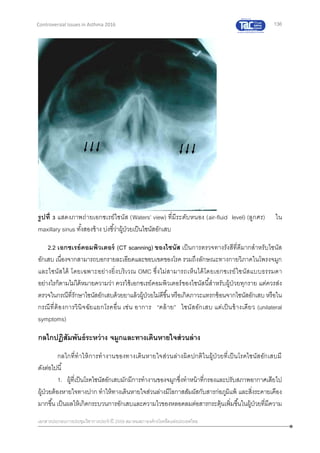 136
เอกสารประกอบการประชุมวิชาการประจาปี 2559 สมาคมสภาองค์กรโรคหืดแห่งประเทศไทย
Controversial Issues in Asthma 2016
รูปที่ 3 แสดงภาพถ่ายเอกซเรย์ไซนัส (Waters’ view) ที่มีระดับหนอง (air-fluid level) (ลูกศร) ใน
maxillary sinus ทั้งสองข้าง บ่งชี้ว่าผู้ป่วยเป็นไซนัสอักเสบ
2.2 เอกซเรย์คอมพิวเตอร์ (CT scanning) ของไซนัส เป็นการตรวจทางรังสีที่ดีมากสาหรับไซนัส
อักเสบ เนื่องจากสามารถบอกรายละเอียดและขอบเขตของโรค รวมถึงลักษณะทางกายวิภาคในโพรงจมูก
และไซนัสได้ โดยเฉพาะอย่างยิ่งบริเวณ OMC ซึ่งไม่สามารถเห็นได้โดยเอกซเรย์ไซนัสแบบธรรมดา
อย่างไรก็ตามไม่ได้หมายความว่า ควรใช้เอกซเรย์คอมพิวเตอร์ของไซนัสนี้สาหรับผู้ป่วยทุกราย แต่ควรส่ง
ตรวจในกรณีที่รักษาไซนัสอักเสบด้วยยาแล้วผู้ป่วยไม่ดีขึ้นหรือเกิดภาวะแทรกซ้อนจากไซนัสอักเสบ หรือใน
กรณีที่ต้องการวินิจฉัยแยกโรคอื่น เช่น อาการ “คล้าย” ไซนัสอักเสบ แต่เป็นข้างเดียว (unilateral
symptoms)
กลไกปฏิสัมพันธ์ระหว่าง จมูกและทางเดินหายใจส่วนล่าง
กลไกที่ทาให้การทางานของทางเดินหายใจส่วนล่างผิดปกติในผู้ป่วยที่เป็นโรคไซนัสอักเสบมี
ดังต่อไปนี้
1. ผู้ที่เป็นโรคไซนัสอักเสบมักมีการทางานของจมูกซึ่งทาหน้าที่กรองและปรับสภาพอากาศเสียไป
ผู้ป่วยต้องหายใจทางปาก ทาให้ทางเดินหายใจส่วนล่างมีโอกาสสัมผัสกับสารก่อภูมิแพ้ และสิ่งระคายเคือง
มากขึ้น เป็นผลให้เกิดกระบวนการอักเสบและความไวของหลอดลมต่อสารกระตุ้นเพิ่มขึ้นในผู้ป่วยที่มีความ
 