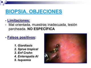 BIOPSIA. OBJECIONES
- Limitaciones:
- Mal orientada, muestras inadecuada, lesión
parcheada. NO ESPECÍFICA
- Falsos positivos:
1. Giardiasis
2. Sprue tropical
3. Enf Crohn
4. Enteropatía AI
5. Isquemia
 