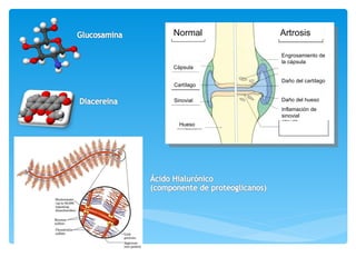 Normal Artrosis Engrosamiento de la cápsula Daño del cartílago Daño del hueso Inflamación de sinovial Cápsula Sinovial Car...