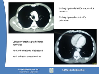 Embolia PulmonarContusión MiocárdicaJuan Pablo Peña Diaz,  MDMedicina de Urgencias