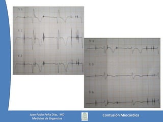 No hay signos de lesión traumática de aortaNo hay signos de contusión pulmonarCorazón y arterias pulmonares normalesNo hay hematoma mediastinalNo hay hemo o neumotóraxContusión MiocárdicaJuan Pablo Peña Diaz,  MDMedicina de Urgencias