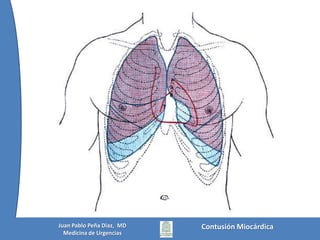 Historia1868: Fischer publicó una serie de 76 casos; 69 de rupturas cardiacas y 7 contusiones miocárdicas1932: Kissane reportó una incidencia del 15 %1935: Bright & Beck: demostraron que de 157 pacientes que falecieron secundariamente a trauma cardiaco cerrado y demostraron que para lograr una ruptura cardiaca se necesitaban fuerzas muy altas y  afirmaron que con fuerzas menores se provocaban cambios casi siempre totalmente reversibles y era muy raro que se presentara una ruptura.Describieron al fenómeno de contusión miocárdica en perros como una hemorragia intersticial con necrosis muscular1940: Leinoff reportó 15 casos fatales en accidentes de tránsito, de los cuales el 16 % revelaban macroscópicamente cambios por contusiónMattox, Moore, Feliciano. TRAUMA, Chap 28. McGraw-Hill 2006Contusión MiocárdicaJuan Pablo Peña Diaz,  MDMedicina de Urgencias