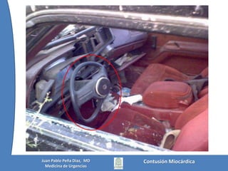 Contusión MiocárdicaJuan Pablo Peña Diaz,  MDMedicina de Urgencias