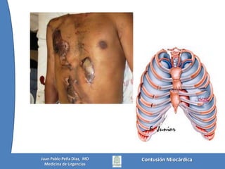 Contusión MiocárdicaJuan Pablo Peña Diaz,  MDMedicina de Urgencias