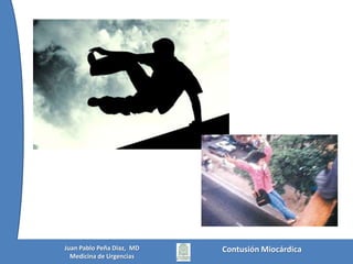 Contusión MiocárdicaJuan Pablo Peña Diaz,  MDMedicina de Urgencias