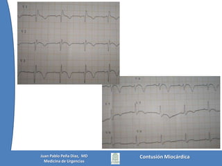  Sostenida (> 36 h) y significativa (TcIn > 2)Edouard AR, Felten ML, Hebert JL,, Cosson C,, Martin L, Benhamou D. Incidence and Significance of Cardiac Troponin I Releasein Severe Trauma Patients. Anesthesiology 2004; 101:1262–8Contusión MiocárdicaJuan Pablo Peña Diaz,  MDMedicina de Urgencias