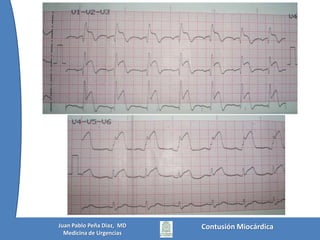  Ruptura traumática de Aorta torácica