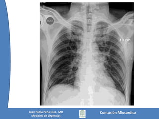  Contusión miocárdica