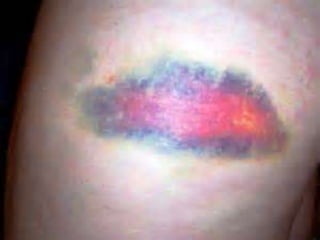 Contusion - A physical injury. It happen by any road accident, falling ...