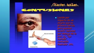 Lesión por
impacto de un
objeto que no
provoca herida
pero pueden
existir lesiones
por debajo de la
piel, ej. “ojo
morado”,
contusión
muscular, etc.

 