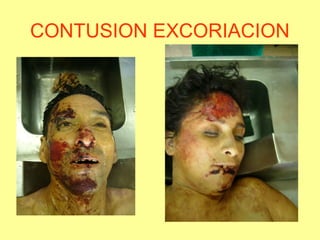 CONTUSION EXCORIACION

 
