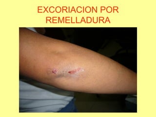 EXCORIACION POR
REMELLADURA

 