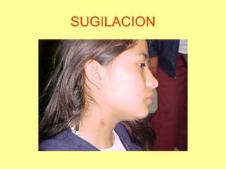 SUGILACION

 