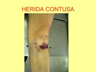 HERIDA CONTUSA

 