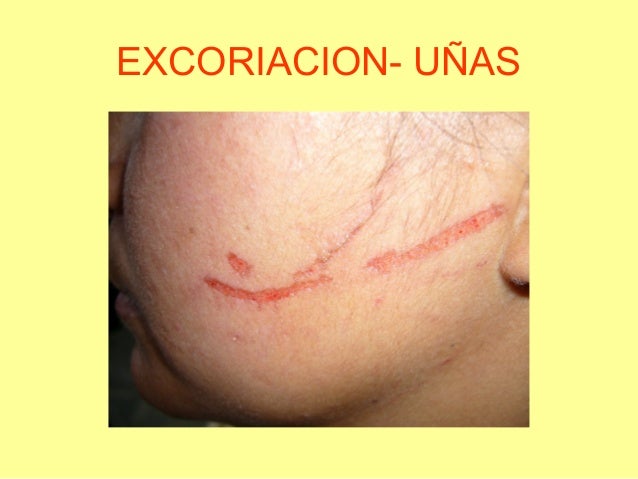 Contusiones cruz roja