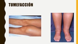 TUMEFACCIÓN