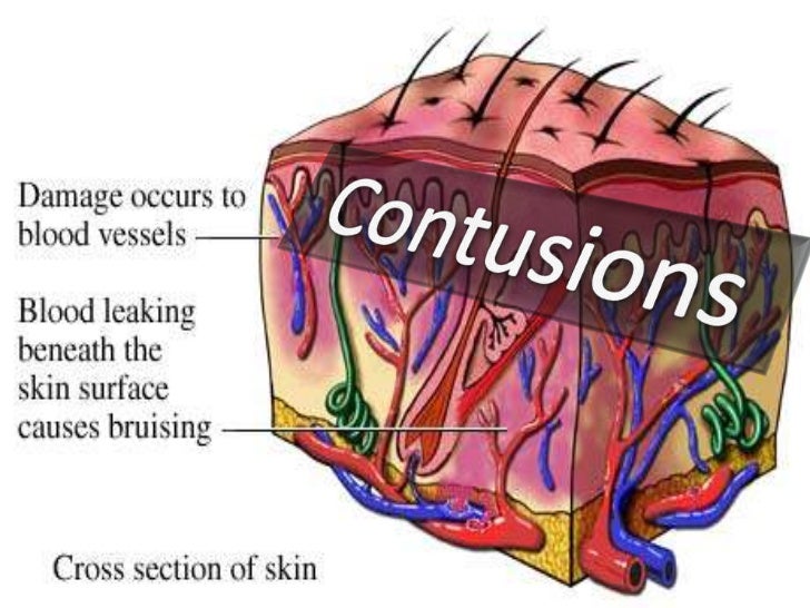 Contusions & abrasions