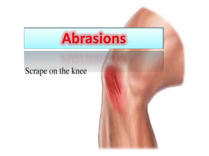 Contusions & abrasions