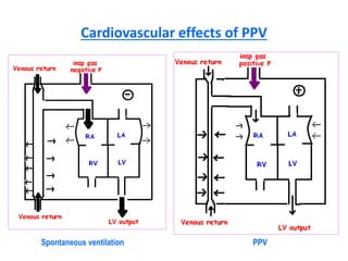 Cardiovascular effects of PPV
Spontaneous ventilation PPV
 