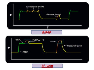 BiPAP
Bi- vent
 