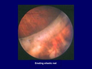 Silactic Rods The Indirect Ophthalmoscope | PPT